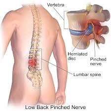 Low_back_pinched_nerve