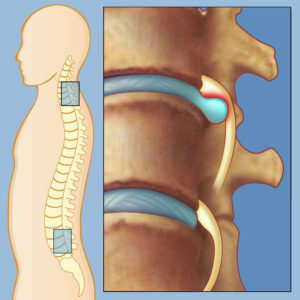 herniated-disc-lg